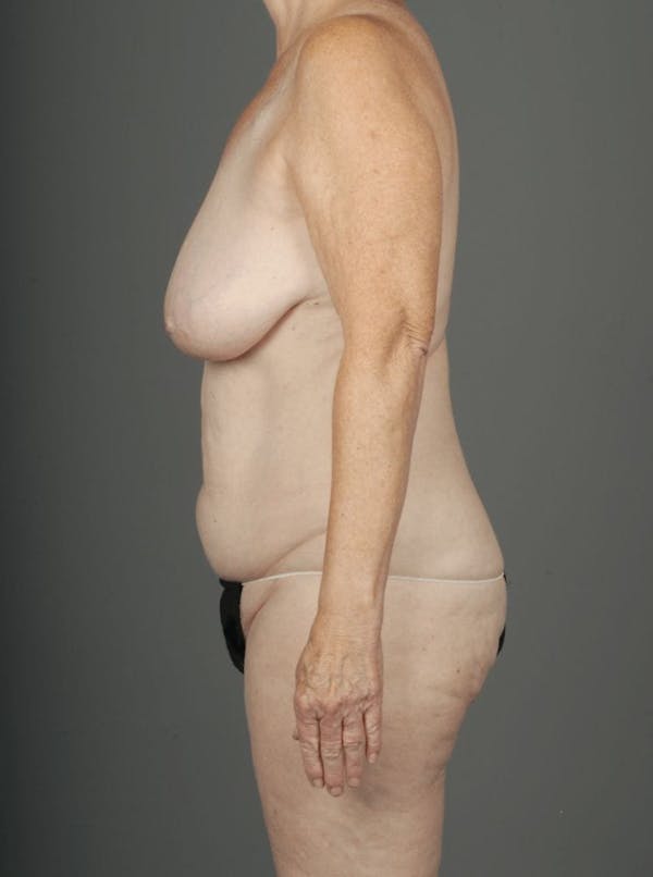 DIEP Flap Before & After Gallery - Patient 4006384 - Image 7