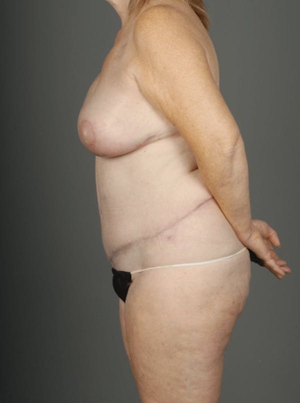 DIEP Flap Before & After Gallery - Patient 4006384 - Image 8