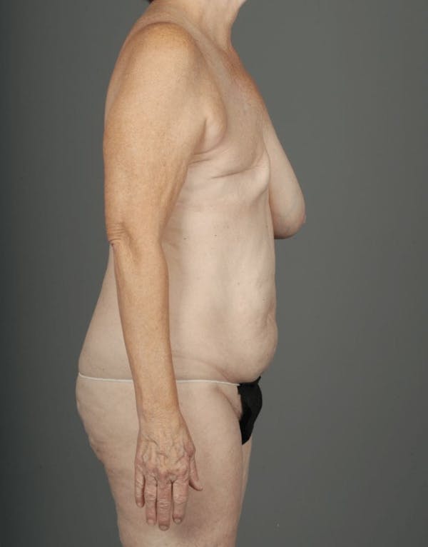 DIEP Flap Before & After Gallery - Patient 4006384 - Image 9