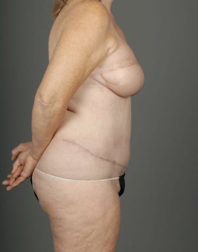 DIEP Flap Before & After Gallery - Patient 4006384 - Image 10