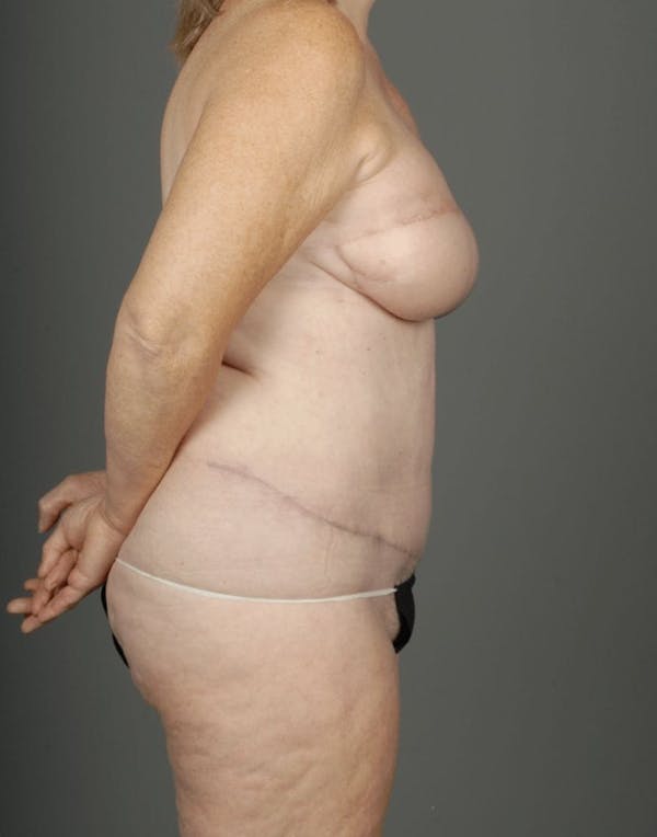 DIEP Flap Before & After Gallery - Patient 4006384 - Image 10