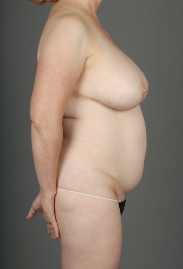 SHaEP Flap Before & After Gallery - Patient 4006536 - Image 7