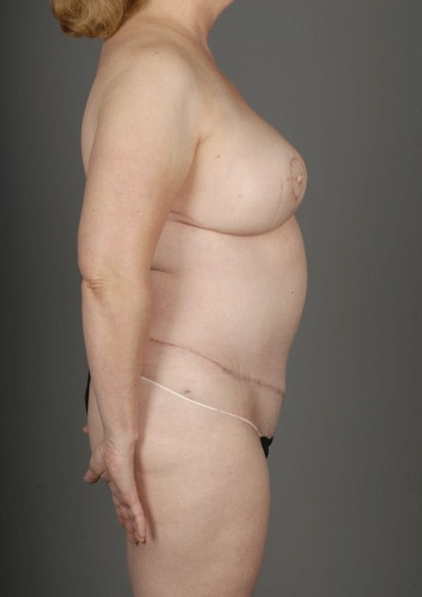 SHaEP Flap Before & After Gallery - Patient 4006536 - Image 8