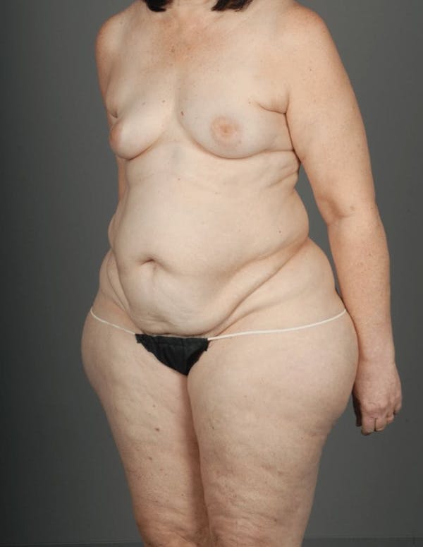 LTP Flap Before & After Gallery - Patient 3688752 - Image 3