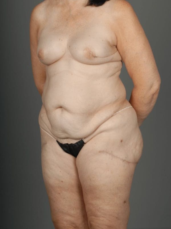 LTP Flap Before & After Gallery - Patient 3688752 - Image 4