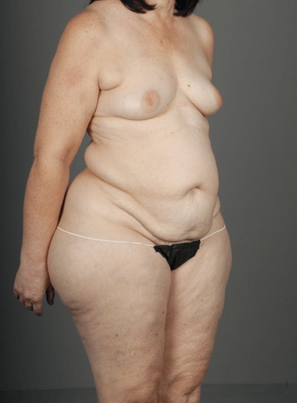 LTP Flap Before & After Gallery - Patient 3688752 - Image 5