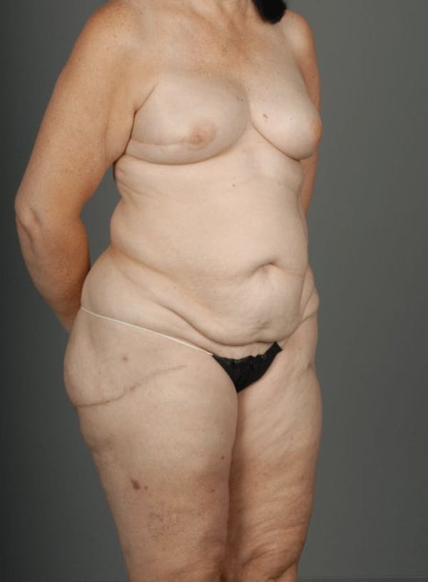 LTP Flap Before & After Gallery - Patient 3688752 - Image 6