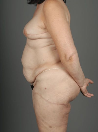 LTP Flap Before & After Gallery - Patient 3688752 - Image 8