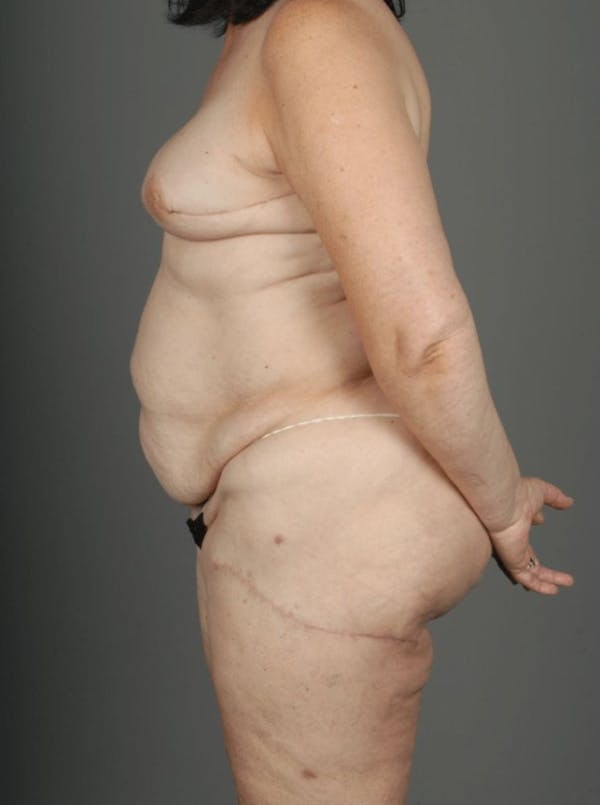 LTP Flap Before & After Gallery - Patient 3688752 - Image 8