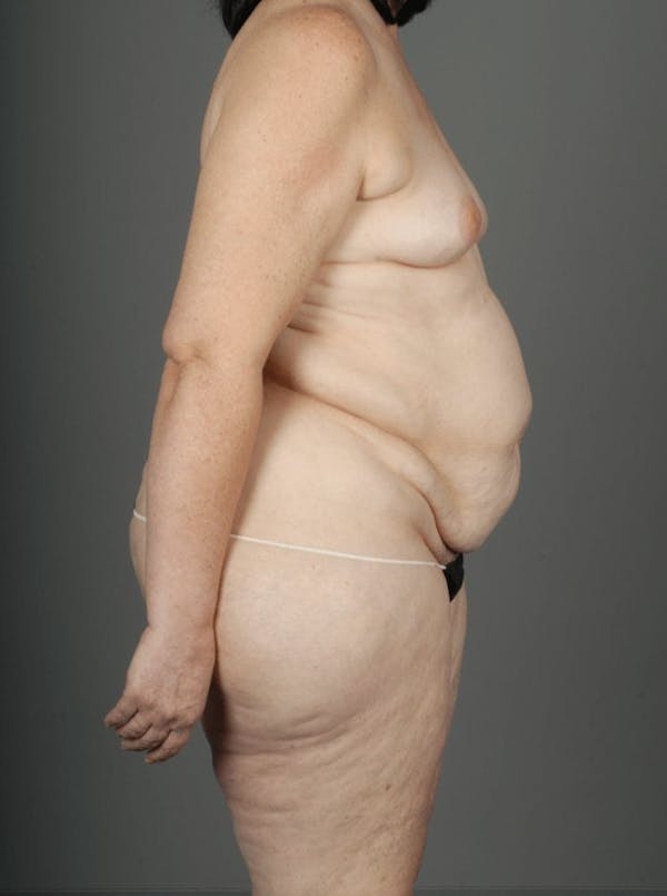 LTP Flap Before & After Gallery - Patient 3688752 - Image 9