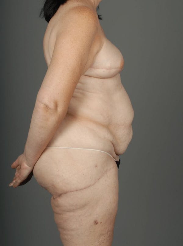 LTP Flap Before & After Gallery - Patient 3688752 - Image 10