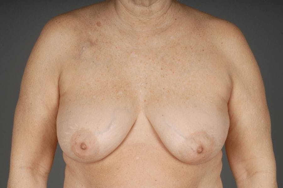 Oncoplastic Reconstruction Results