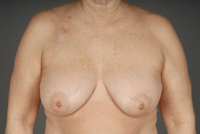 Oncoplastic Reconstruction Before & After Gallery - Patient 3688754 - Image 1