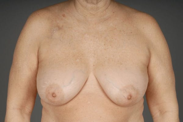 Oncoplastic Reconstruction Before & After Gallery - Patient 3688754 - Image 1
