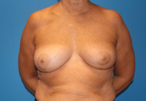 Oncoplastic Reconstruction Before & After Gallery - Patient 3688754 - Image 2