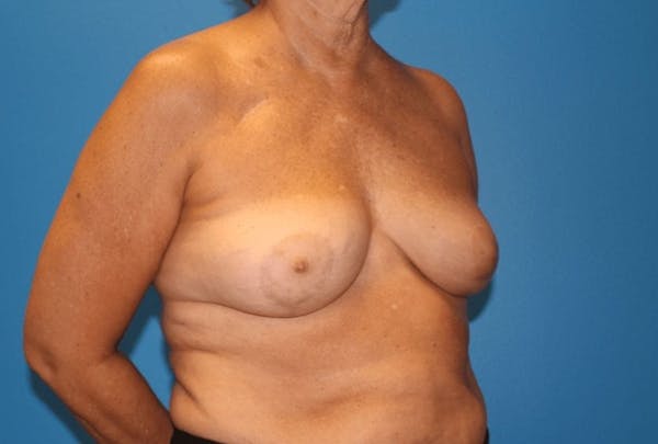 Oncoplastic Reconstruction Before & After Gallery - Patient 3688754 - Image 6