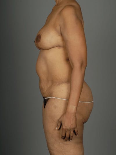 PAP Flap Before & After Gallery - Patient 3688750 - Image 8