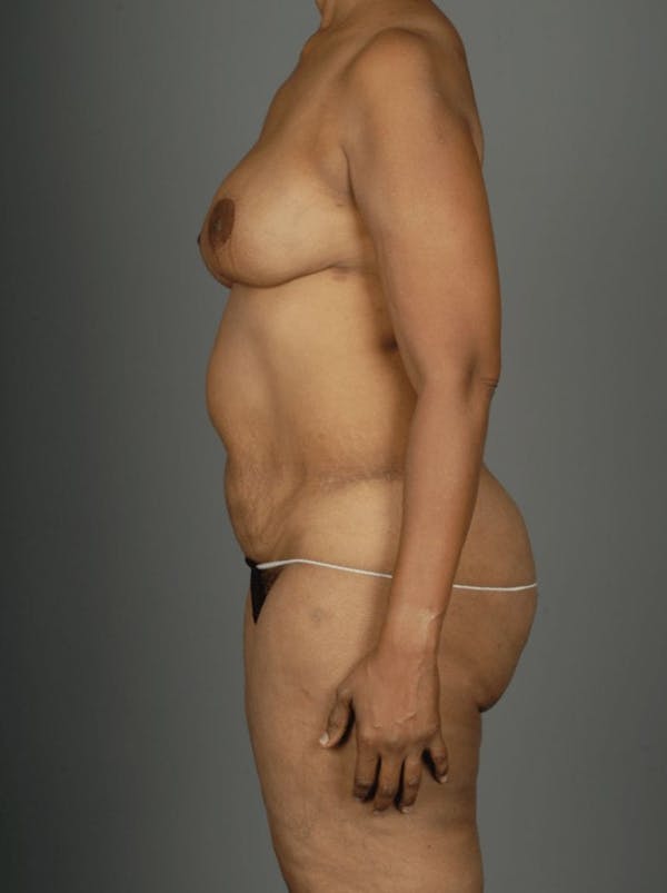 PAP Flap Before & After Gallery - Patient 3688750 - Image 8