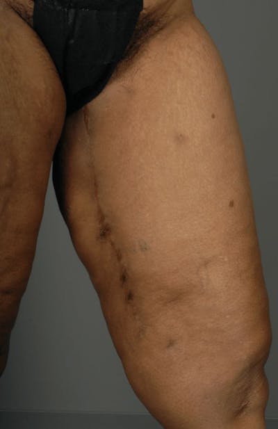 PAP Flap Before & After Gallery - Patient 3688750 - Image 12