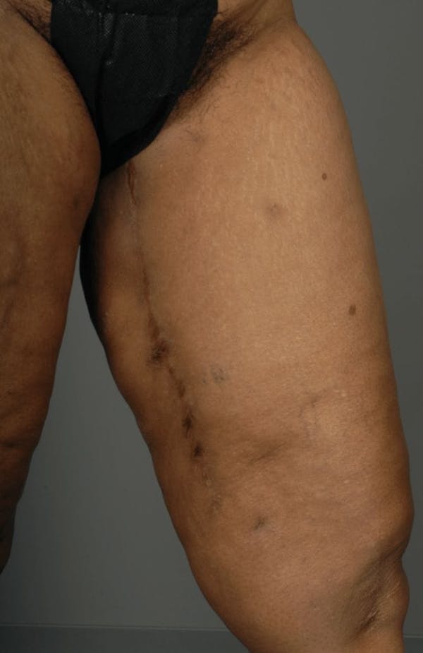 PAP Flap Before & After Gallery - Patient 3688750 - Image 12