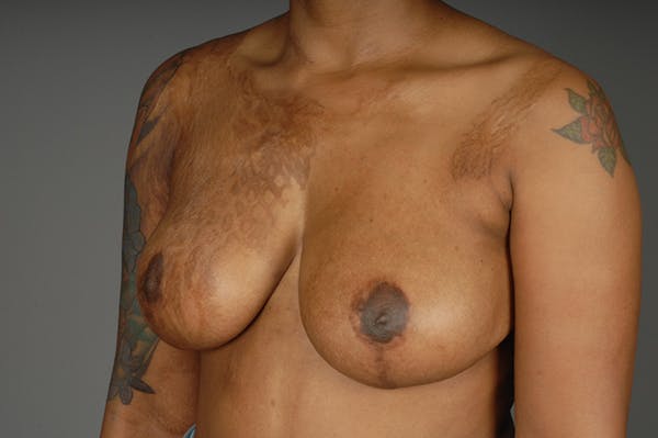 Staged Implant-Based Reconstruction Before & After Gallery - Patient 3689078 - Image 3