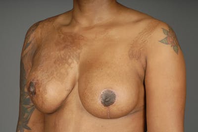 Staged Implant-Based Reconstruction Before & After Gallery - Patient 3689078 - Image 4