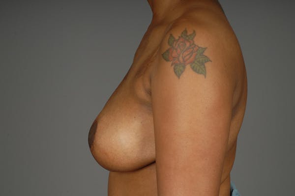 Staged Implant-Based Reconstruction Before & After Gallery - Patient 3689078 - Image 7