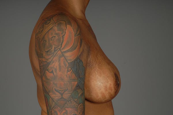 Staged Implant-Based Reconstruction Before & After Gallery - Patient 3689078 - Image 9