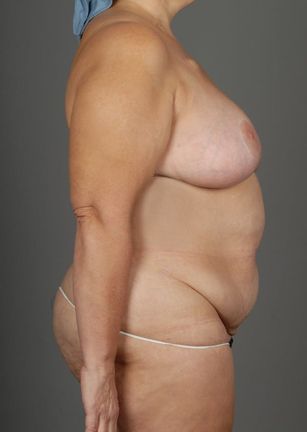 DIEP Flap Before & After Gallery - Patient 4006302 - Image 9