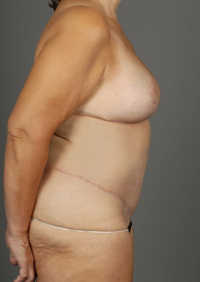 Deep Inferior Epigastric Artery Perforator Flap Before & After Gallery - Patient 4006302 - Image 10