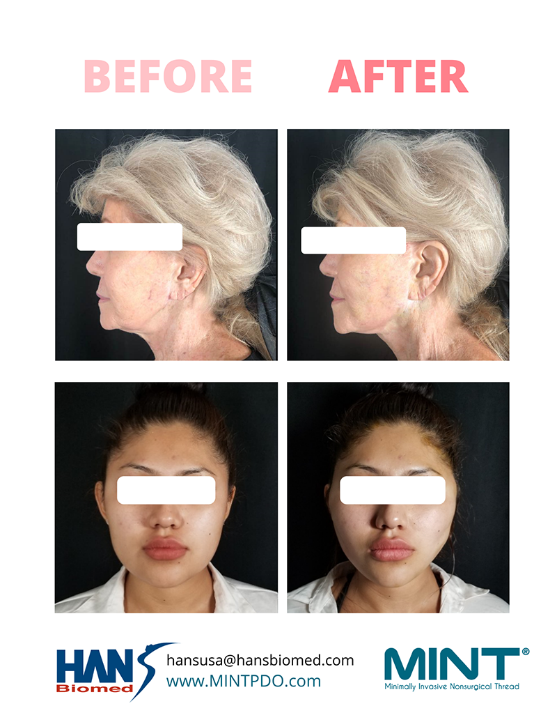 PDO THREADS - New York Facial & Body Rejuvenation