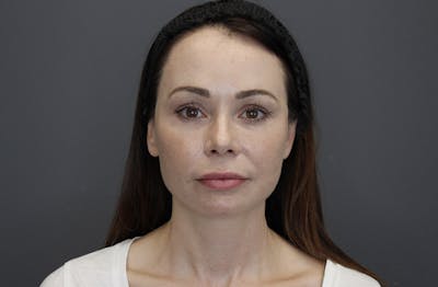 Injectables Before & After Gallery - Patient 8487350 - Image 2