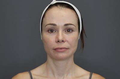 Injectables Before & After Gallery - Patient 8487350 - Image 1