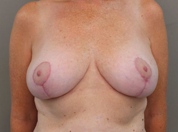 Oncoplastic Reconstruction Before & After Gallery - Patient 8693689 - Image 2