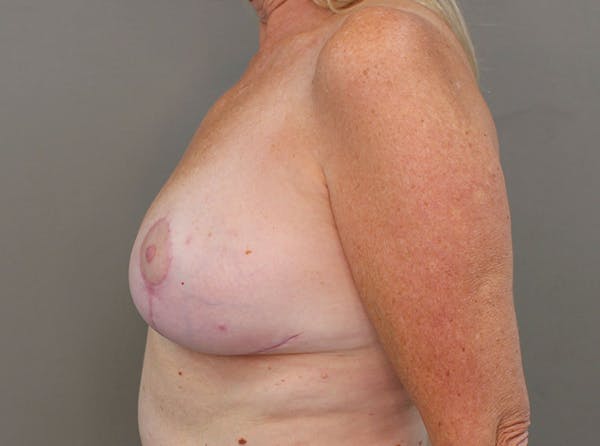 Oncoplastic Reconstruction Before & After Gallery - Patient 8693689 - Image 6