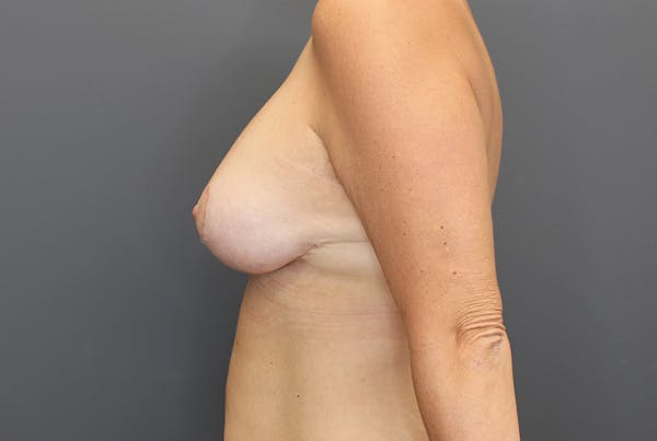 Breast Augmentation Revision Before & After Gallery - Patient 9863628 - Image 6