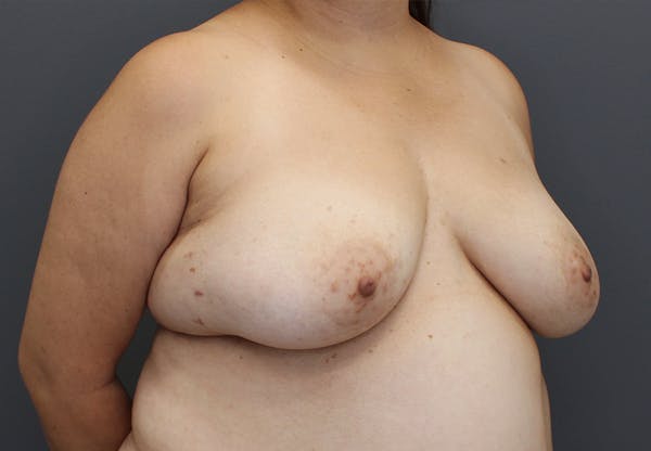 Oncoplastic Reconstruction Before & After Gallery - Patient 10379692 - Image 7