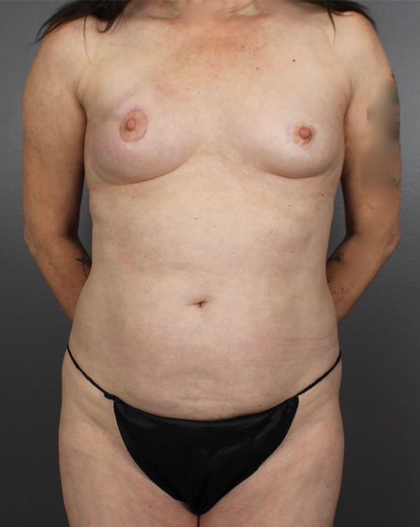 Deep Inferior Epigastric Artery Perforator Flap Before & After Gallery - Patient 146899764 - Image 1