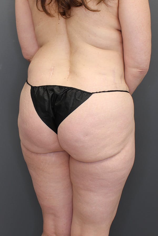 Four Flap Before & After Gallery - Patient 148128875 - Image 7