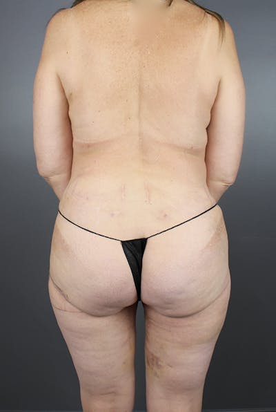 Four Flap Before & After Gallery - Patient 148128875 - Image 10