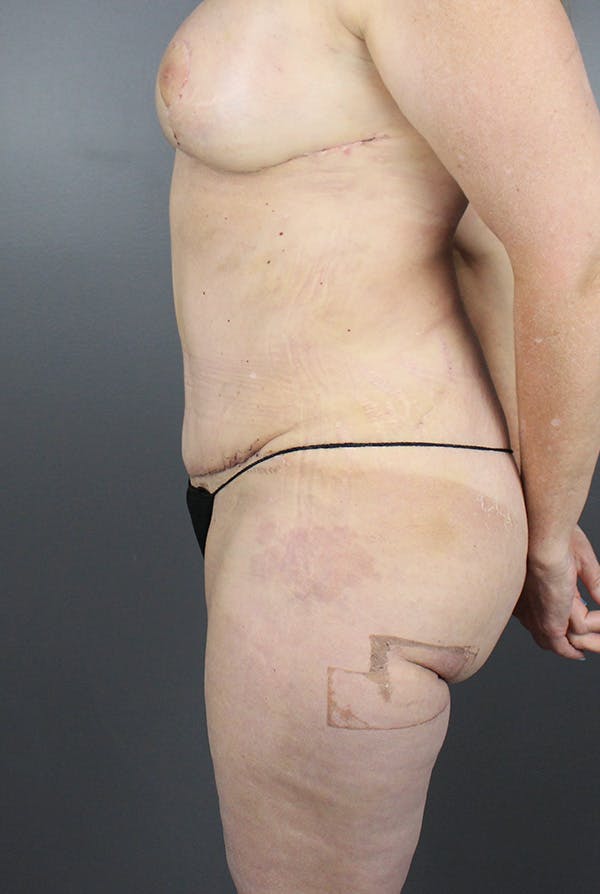 Four Flap Before & After Gallery - Patient 148128875 - Image 14