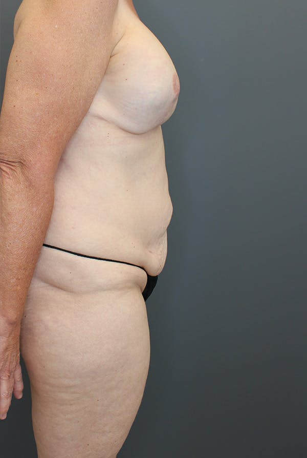 Four Flap Before & After Gallery - Patient 148223829 - Image 5