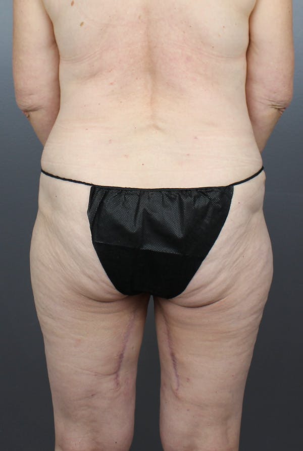 Four Flap Before & After Gallery - Patient 148223829 - Image 10