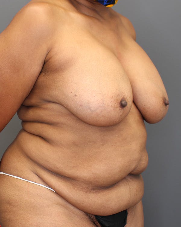 DIEP Flap Before & After Gallery - Patient 149051000 - Image 3