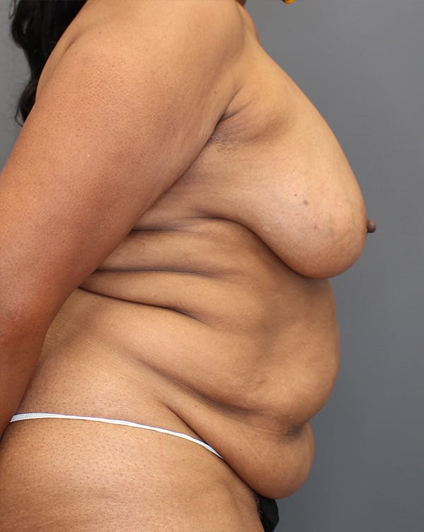 DIEP Flap Before & After Gallery - Patient 149051000 - Image 5