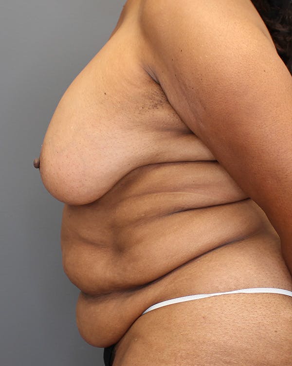 DIEP Flap Before & After Gallery - Patient 149051000 - Image 9