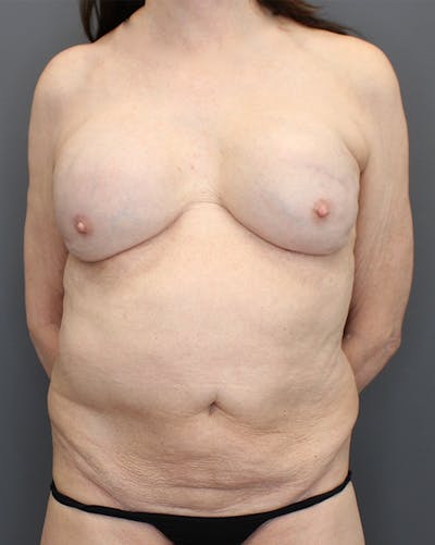 Hybrid Before & After Gallery - Patient 149051004 - Image 1