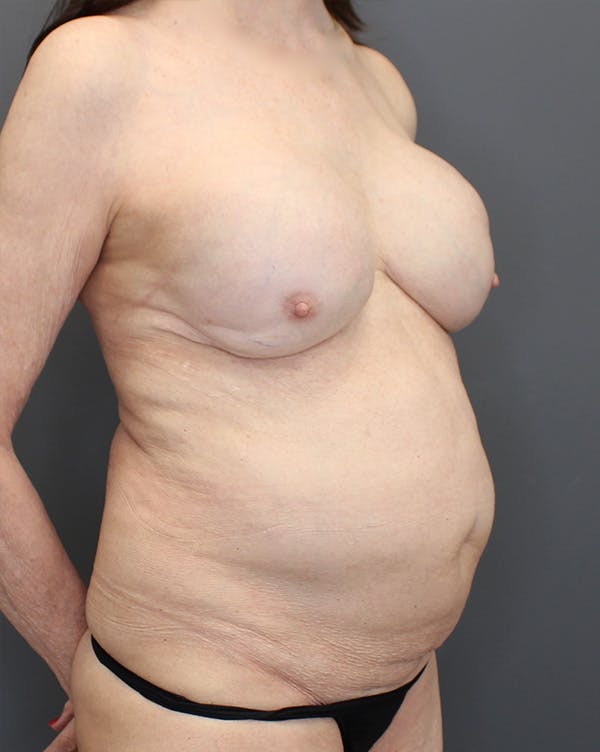 Hybrid Before & After Gallery - Patient 149051004 - Image 3