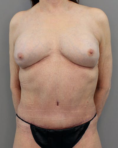 Hybrid Before & After Gallery - Patient 149051004 - Image 2