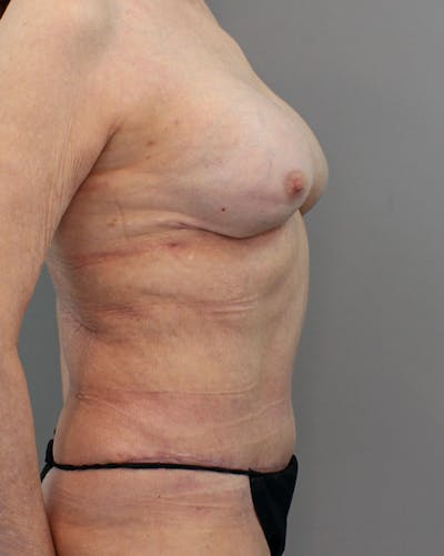 Hybrid Before & After Gallery - Patient 149051004 - Image 6